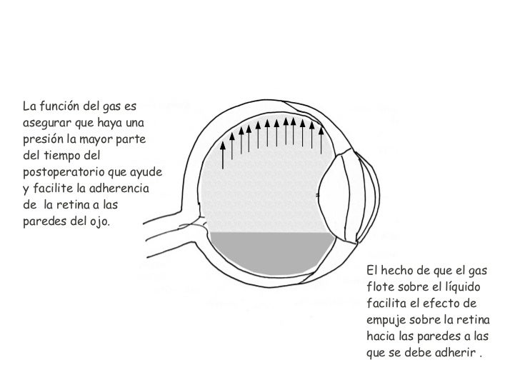 Postoperatorio desprendimiento de retina