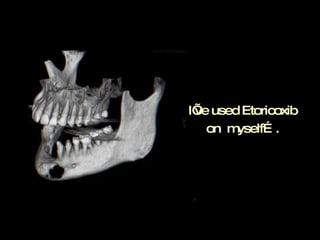 I’ve used Etoricoxib on  myself…. 