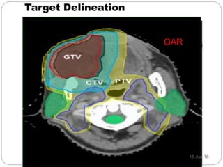 Post op radiotherapy in oral cavity cancers | PPTX