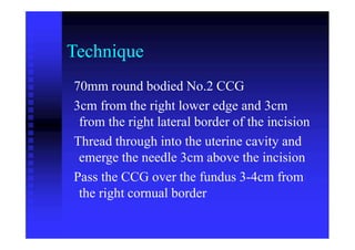 Technique
70mm round bodied No.2 CCG
3cm from the right lower edge and 3cm
from the right lateral border of the incision
Thread through into the uterine cavity and
emerge the needle 3cm above the incision
Pass the CCG over the fundus 3-4cm from
the right cornual border
 