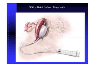 SOS – Bakri Balloon Tamponade
 