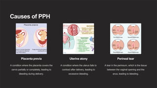 Causes of PPH
Placenta previa
A condition where the placenta covers the
cervix partially or completely, leading to
bleeding during delivery.
Uterine atony
A condition where the uterus fails to
contract after delivery, leading to
excessive bleeding.
Perineal tear
A tear in the perineum, which is the tissue
between the vaginal opening and the
anus, leading to bleeding.
 