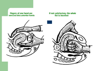 Fingers of one hand are    If not satisfactory, the whole  pressed into anterior fornix    fist is inserted 