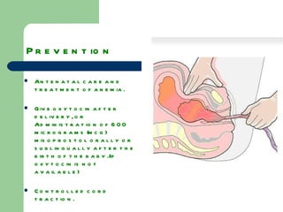 Prevention   Antenatal care and treatment of anemia. Give oxytocin after delivery, or  Administration of 600 micrograms (mcg) misoprostol orally or sublingually after the birth of the baby.(if oxytocin is not available) Controlled cord traction. Uterine massage after delivery of placenta. 