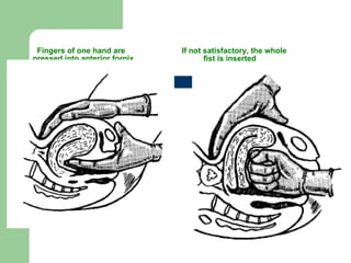 Fingers of one hand are    If not satisfactory, the whole  pressed into anterior fornix    fist is inserted 
