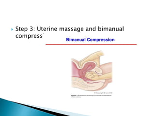  Step 3: Uterine massage and bimanual
compression
 