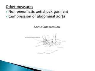 Other measures
 Non pneumatic antishock garment
 Compression of abdominal aorta
 