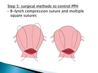 Step 5: surgical methods to control PPH
 B-lynch compression suture and multiple
square sutures
 