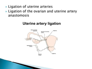  Ligation of uterine arteries
 Ligation of the ovarian and uterine artery
anastomosis
 