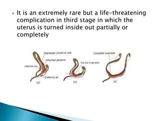  It is an extremely rare but a life-threatening
complication in third stage in which the
uterus is turned inside out partially or
completely
 