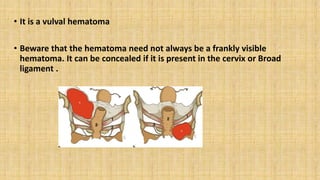 • It is a vulval hematoma
• Beware that the hematoma need not always be a frankly visible
hematoma. It can be concealed if it is present in the cervix or Broad
ligament .
 