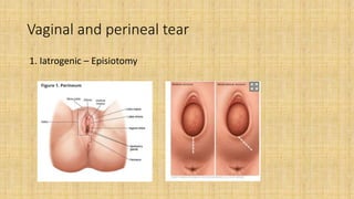 Vaginal and perineal tear
1. Iatrogenic – Episiotomy
 