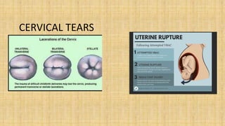 CERVICAL TEARS
 