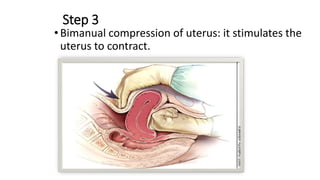 Step 3
•Bimanual compression of uterus: it stimulates the
uterus to contract.
 
