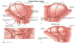 1
2
3 4
5
6
4 3
1
2 5
6
B-lynch “Brace” suture
Anterior view
Posterior view
 