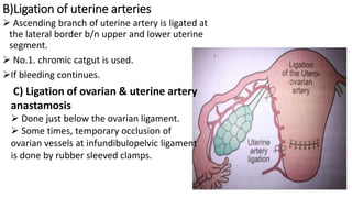 B)Ligation of uterine arteries
 Ascending branch of uterine artery is ligated at
the lateral border b/n upper and lower uterine
segment.
 No.1. chromic catgut is used.
If bleeding continues.
C) Ligation of ovarian & uterine artery
anastamosis
 Done just below the ovarian ligament.
 Some times, temporary occlusion of
ovarian vessels at infundibulopelvic ligament
is done by rubber sleeved clamps.
 