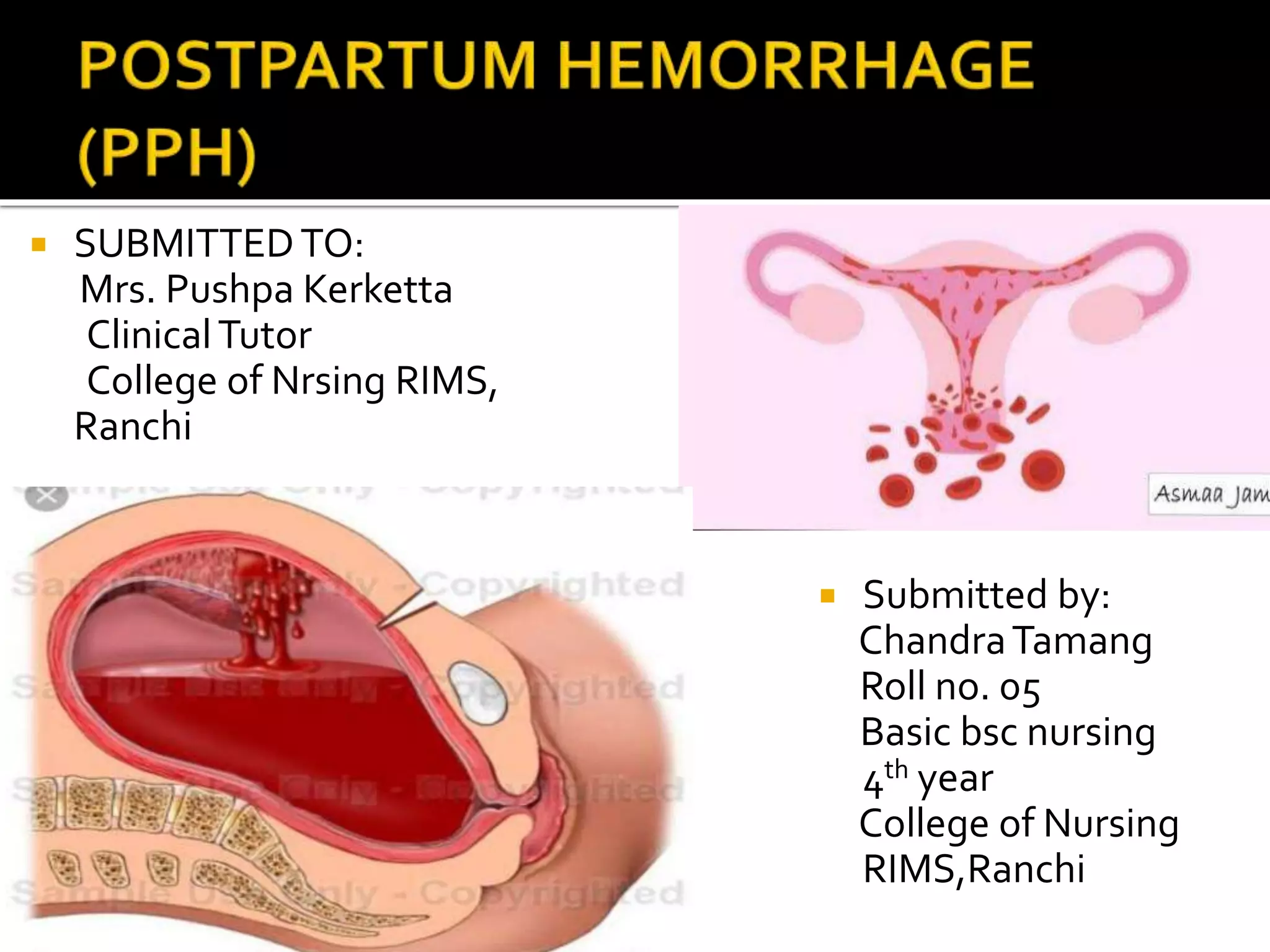 Post partum hemorrhage obs and gyne | PPTX
