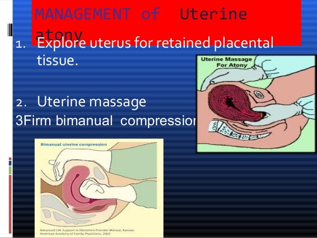 Postpartum Hemorrhage For Undergraduate postpartum-hemorrhage-for-undergraduate