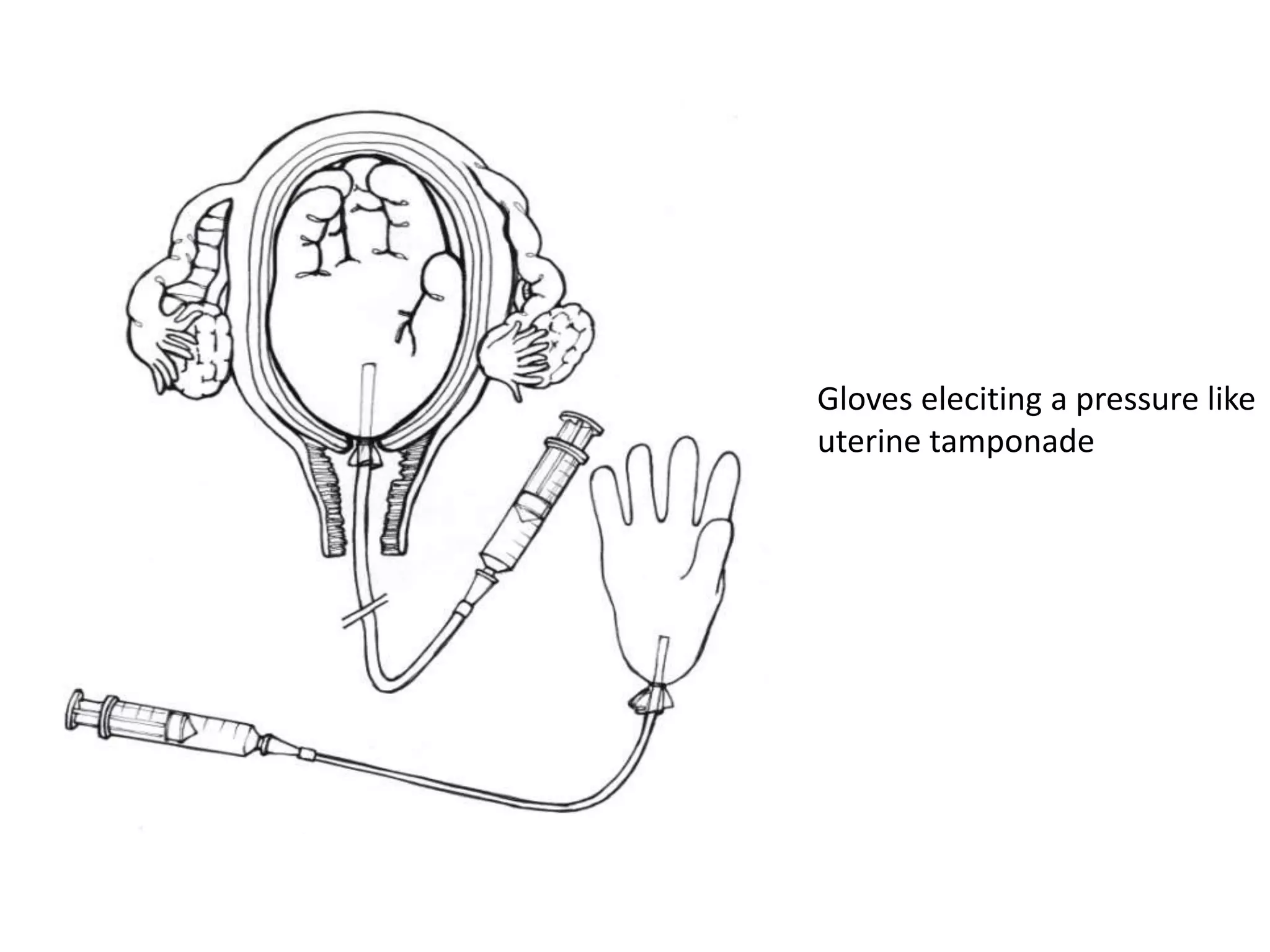 Gloves eleciting a pressure like
uterine tamponade
 