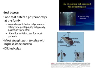 Ideal access:
• one that enters a posterior calyx
at the fornix
• second most inferior calyx seen on
retrograde pyelography is typically
posteriorly oriented
• ideal for initial access for most
patients
• Most straight path to calyx with
highest stone burden
• Dilated calyx
 
