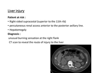 Liver injury
Patient at risk :
• Right-sided supracostal (superior to the 11th rib)
• percutaneous renal access anterior to the posterior axillary line.
• Hepatomegaly
Diagnosis :
unusual burning sensation at the right flank
CT scan to reveal the route of injury to the liver
 