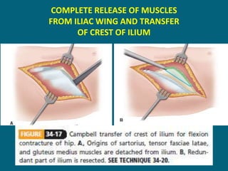 COMPLETE RELEASE OF MUSCLES
FROM ILIAC WING AND TRANSFER
OF CREST OF ILIUM
 
