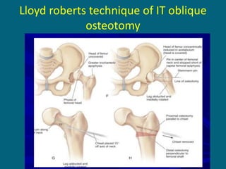 Lloyd roberts technique of IT oblique
osteotomy
 
