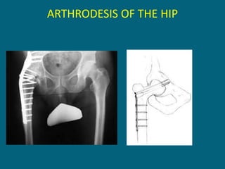 ARTHRODESIS OF THE HIP
 