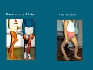 Flexion contracture of the knee Genu recurvatum
 