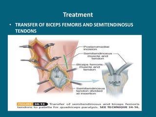 Treatment
• TRANSFER OF BICEPS FEMORIS AND SEMITENDINOSUS
TENDONS
 