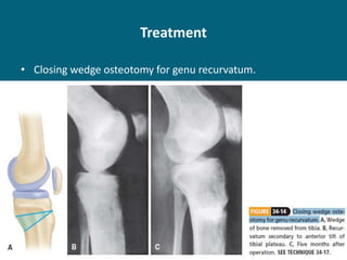 Treatment
• Closing wedge osteotomy for genu recurvatum.
 