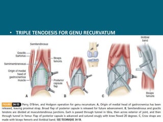 • TRIPLE TENODESIS FOR GENU RECURVATUM
 