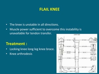 FLAIL KNEE
• The knee is unstable in all directions.
• Muscle power sufficient to overcome this instability is
unavailable for tendon transfer.
Treatment :
• Locking knee long leg knee brace.
• Knee arthrodesis
 
