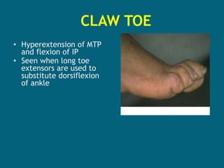 CLAW TOE
• Hyperextension of MTP
and flexion of IP
• Seen when long toe
extensors are used to
substitute dorsiflexion
of ankle
 
