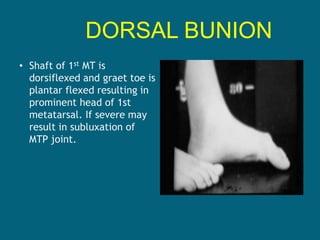 DORSAL BUNION
• Shaft of 1st MT is
dorsiflexed and graet toe is
plantar flexed resulting in
prominent head of 1st
metatarsal. If severe may
result in subluxation of
MTP joint.
 