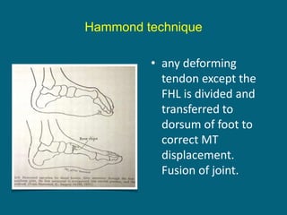 • any deforming
tendon except the
FHL is divided and
transferred to
dorsum of foot to
correct MT
displacement.
Fusion of joint.
Hammond technique
 