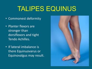 • Commonest deformity
• Planter flexors are
stronger than
dorsiflexors and tight
Tendo Achilles.
• If lateral imbalance is
there Equinuovarus or
Equinovalgus may result.
TALIPES EQUINUS
 