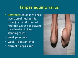 Talipes equino varus
• Deformity: equinus at ankle,
inversion of heel at mid
tarsal joint, adduction of
forefoot. Cavus and clawing
may develop in long
standing cases.
• Weak peroneals
• Weak Tibialis anterior
• Normal triceps surae
 