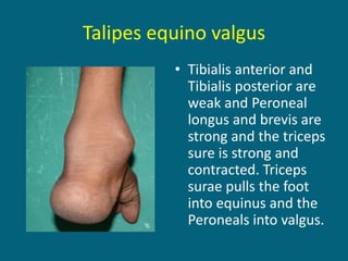 Talipes equino valgus
• Tibialis anterior and
Tibialis posterior are
weak and Peroneal
longus and brevis are
strong and the triceps
sure is strong and
contracted. Triceps
surae pulls the foot
into equinus and the
Peroneals into valgus.
 