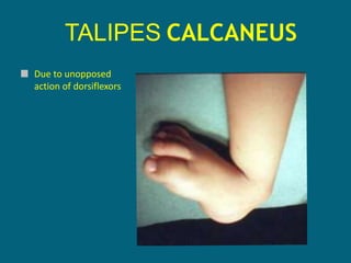 TALIPES CALCANEUS
Due to unopposed
action of dorsiflexors
 