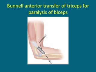 Bunnell anterior transfer of triceps for
paralysis of biceps
 