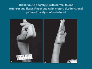 Thenar muscle paralysis with normal thumb
extensor and flexor. Finger and wrist motors also functional
pattern I paralysis of polio hand
 