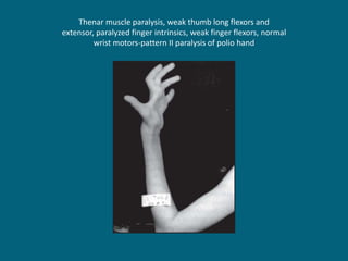 Thenar muscle paralysis, weak thumb long flexors and
extensor, paralyzed finger intrinsics, weak finger flexors, normal
wrist motors-pattern II paralysis of polio hand
 