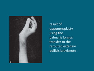 result of
opponensplasty
using the
palmaris longus
transfer to the
rerouted extensor
polllcls brevisnote
 