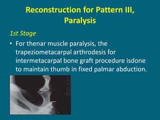 Reconstruction for Pattern III,
Paralysis
1st Stage
• For thenar muscle paralysis, the
trapeziometacarpal arthrodesis for
intermetacarpal bone graft procedure isdone
to maintain thumb in fixed palmar abduction.
 
