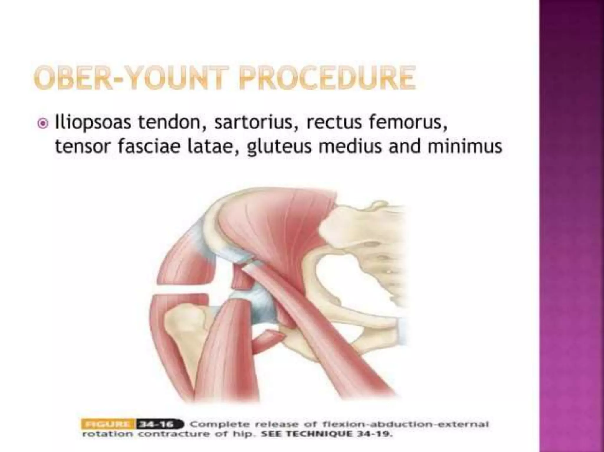 post polio residual paralysis.pptx