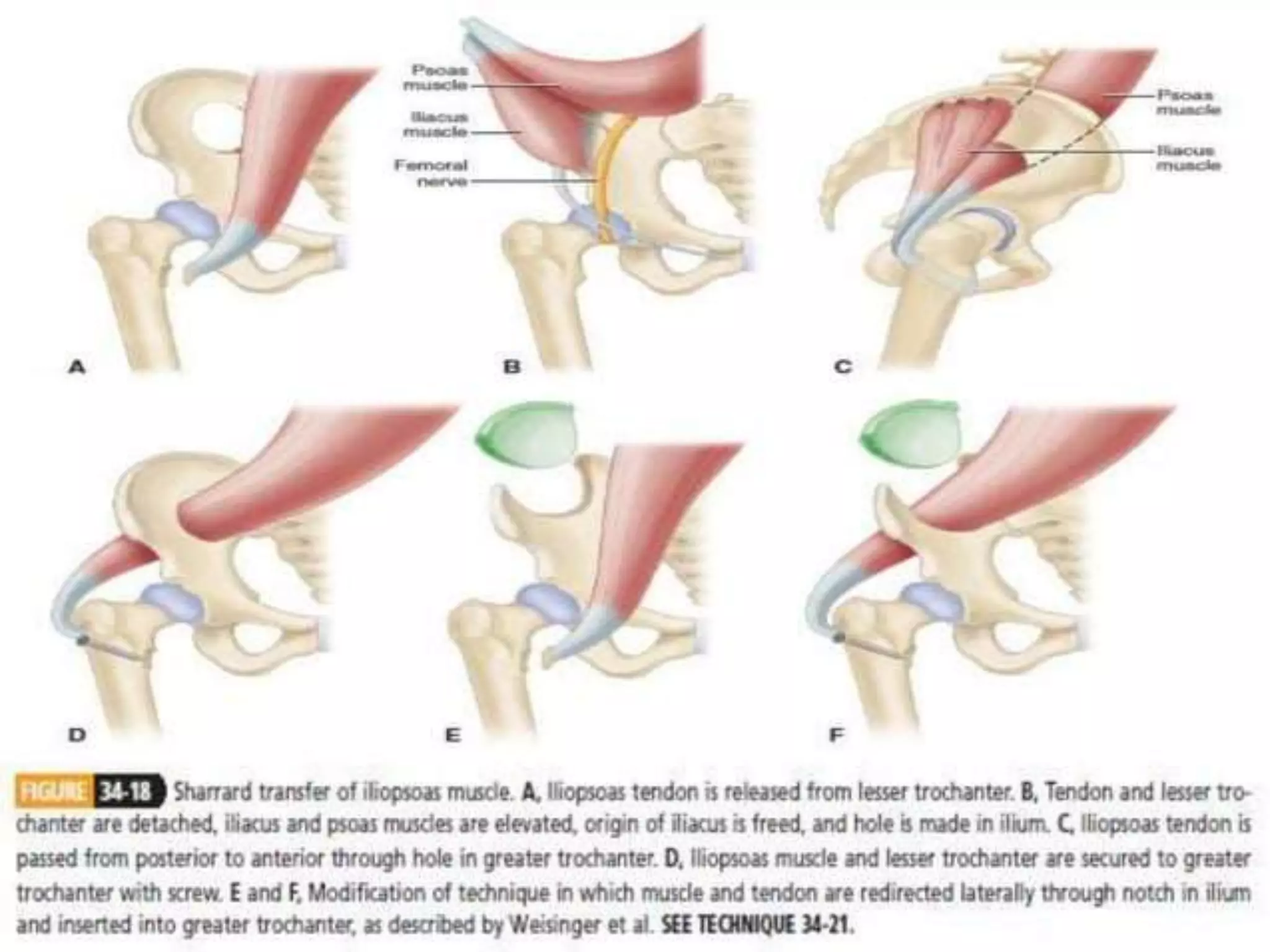 post polio residual paralysis.pptx