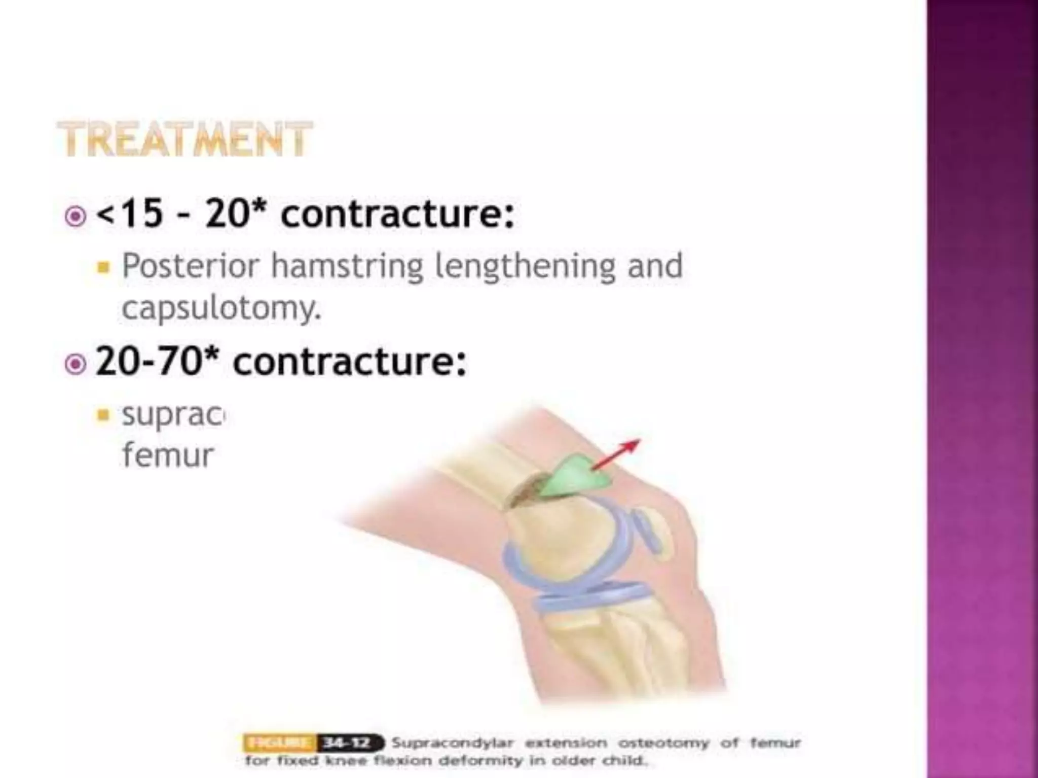 post polio residual paralysis.pptx