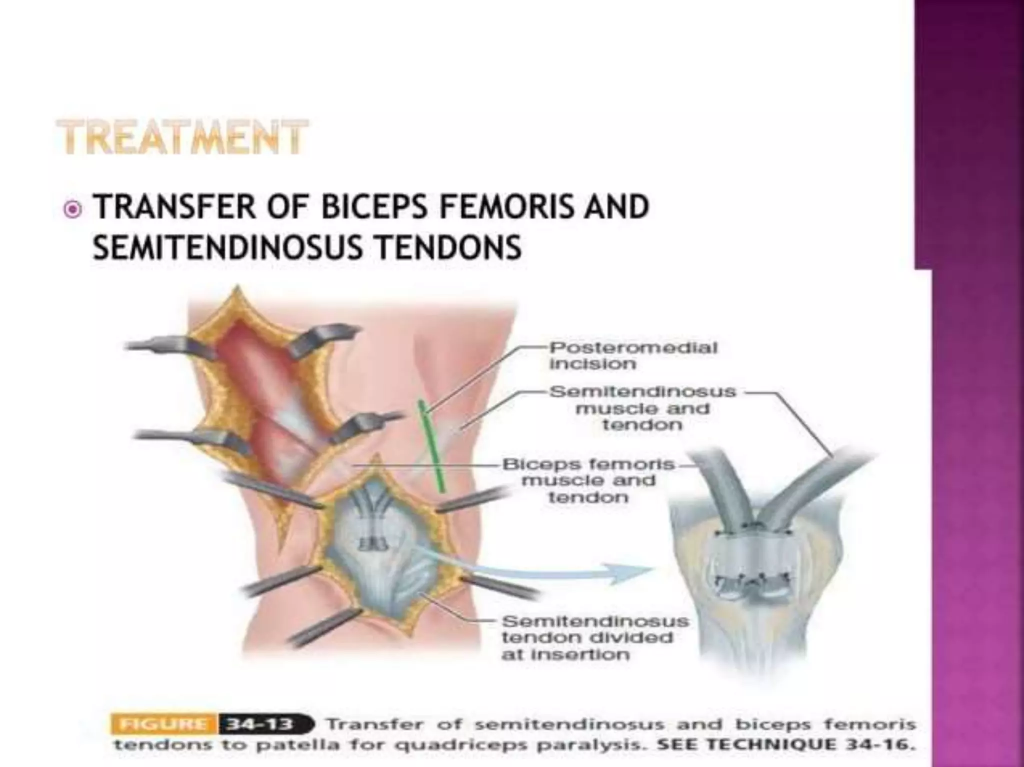 post polio residual paralysis.pptx