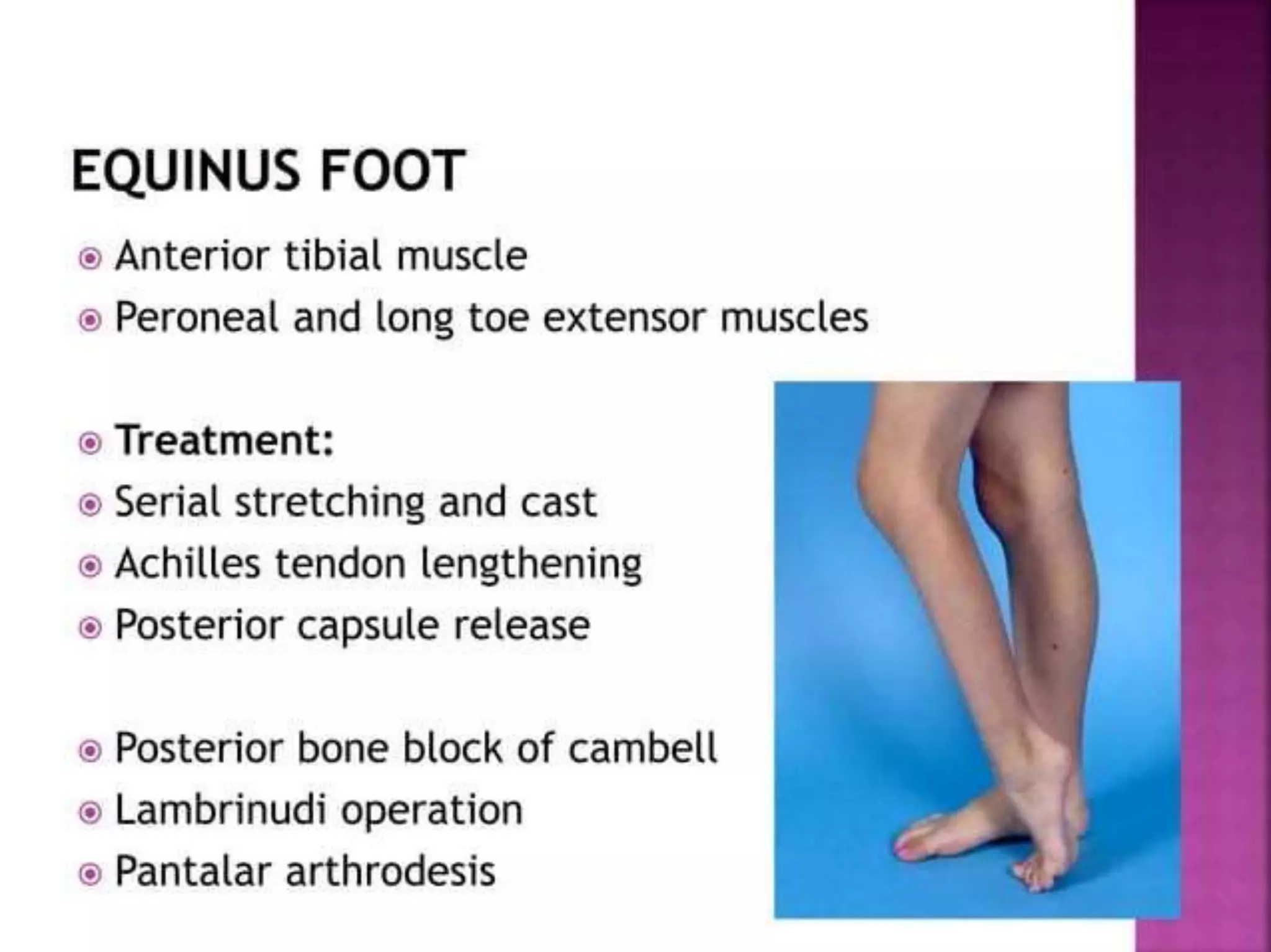 post polio residual paralysis.pptx